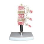 Osteoporoz Kesiti Modeli - Görsel 2