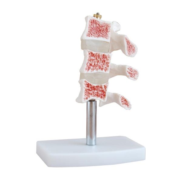 Osteoporoz Kesiti Modeli
